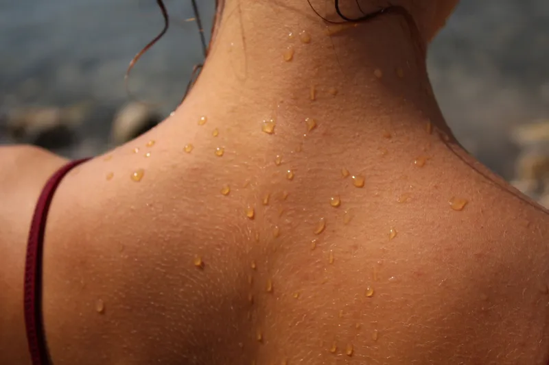 When Should You Get a Skin Cancer Screening?